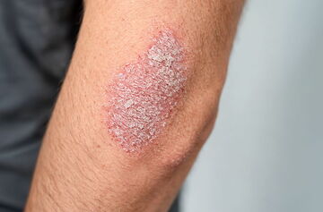 Psoriasis (Schuppenflechte) am Ellenbogen eines Betroffenen