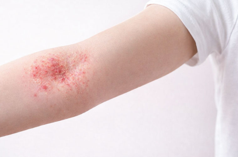 Hautausschlag (Neurodermitis) in der Armbeuge eines Patienten