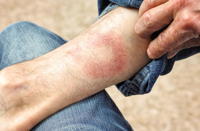 Frühsymptom der Borreliose: Wanderröte (Erythema migrans) nach Zeckenstich.
